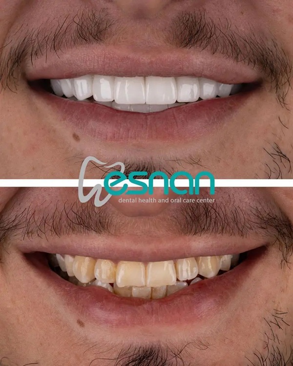 Esnan Dental Centre Before After Teeth Whitening Before and after professional laser teeth whitening treatment at Esnan Dental Centre Istanbul